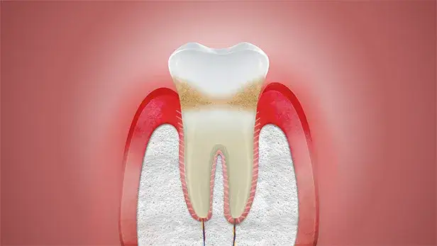 Stan zapalny dziąseł: jak leczyć i zapobiegać? Kompletny poradnik