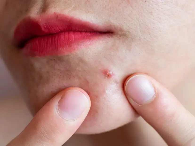 Pryszcze na brodzie: Czy to hormony? Sprawdź, jak je pokonać!