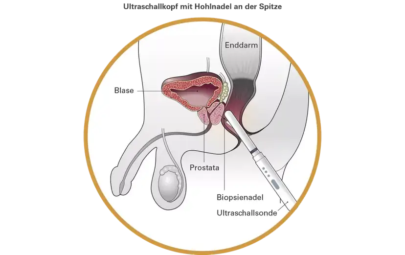 Prostata-Vorsorge ab 30: Wann ist sie wirklich nötig?