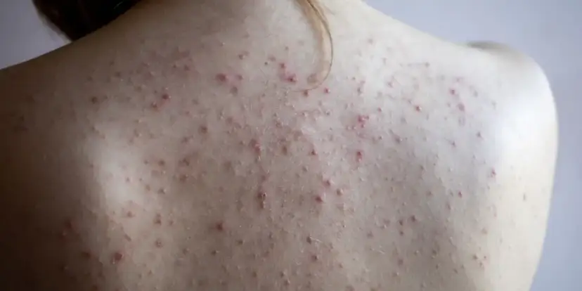 Skuteczne sposoby na pryszcze na plecach - pozbądź się problemu raz na zawsze