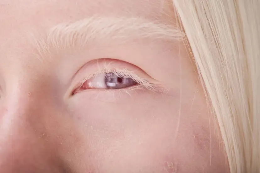 Blond włosy i jasne brwi otaczają fioletowe oczy, świadczące o albinizmie.