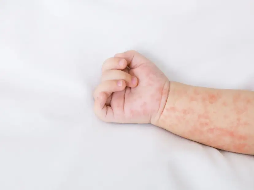 Jak wygląda alergia u niemowlaka? Objawy, które musisz znać