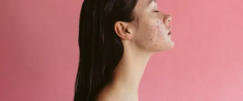 Koniec z ranami po pryszczach! Skuteczna pielęgnacja i usuwanie śladów