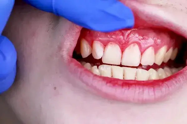 Jakie witaminy wzmacniają dziąsła? Sprawdź, co jeść, by uniknąć problemów