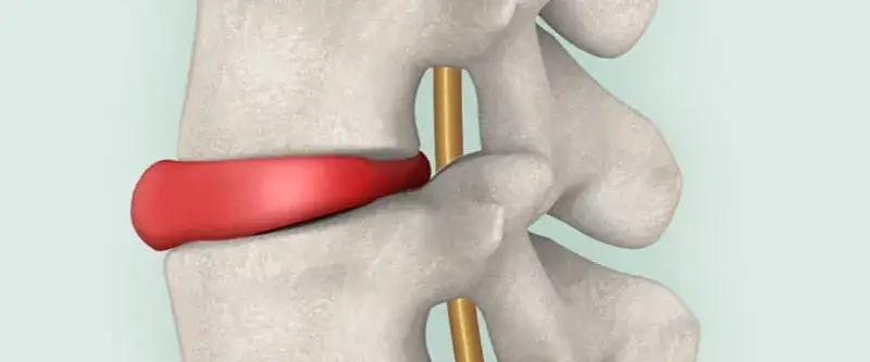 Symptome Bandscheibenvorfall: Warnsignale, die Sie nicht ignorieren sollten