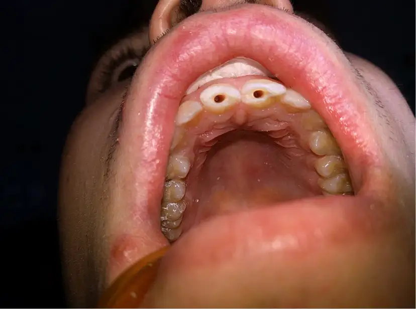 Utracone dziąsła nie odrosną? Poznaj metody leczenia i odbudowy