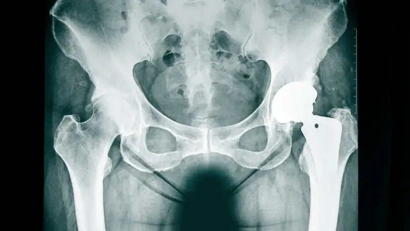 Jak długo odczuwa się ból po endoprotezie biodra? Oczekiwania i fakty