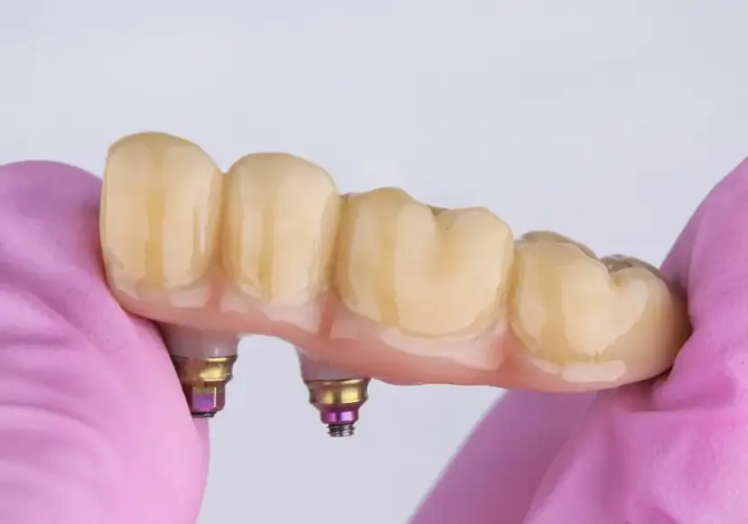 Most protetyczny: Jak wygląda? Estetyka i naturalny uśmiech krok po kroku