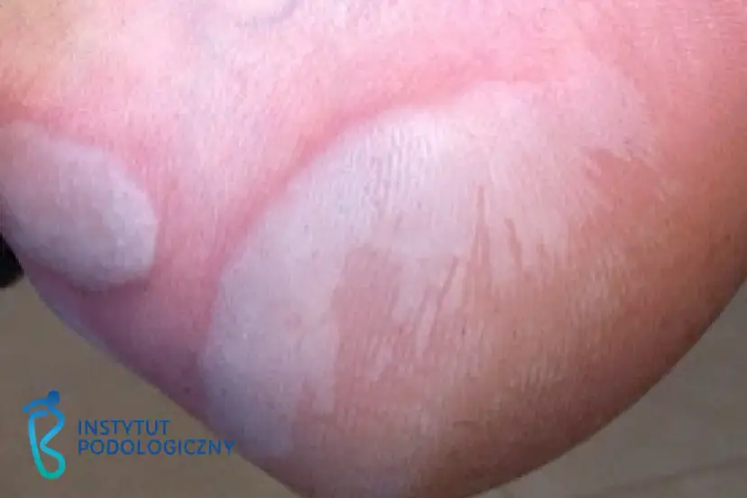 Pęcherze w ustach? Znam sposoby! Szybkie leczenie i ulga