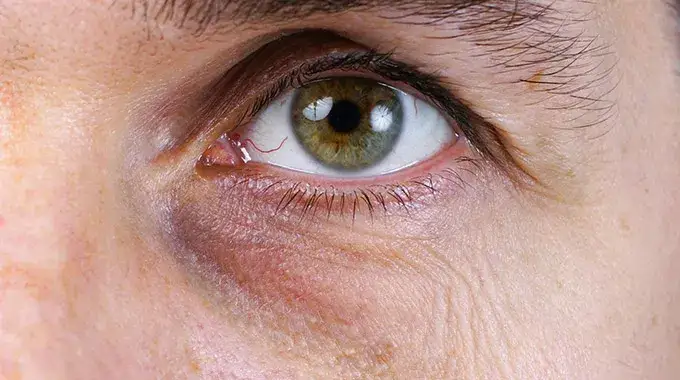Eisenmangel symptome augen: Dunkle Augenringe und ihre Ursachen erkennen