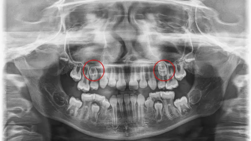 Czy pantomogram jest na NFZ? Sprawdź, co musisz wiedzieć o refundacji