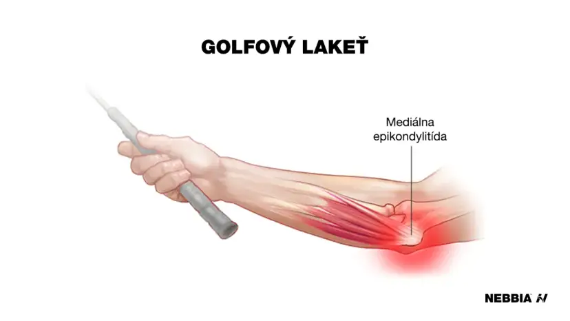 Ból łokcia przy zginaniu? Czy to łokieć tenisisty? Leczenie, ćwiczenia