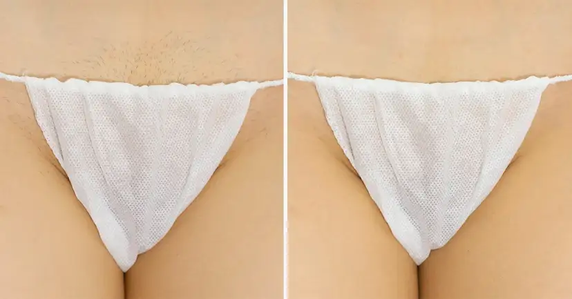 Ile zabiegów laserem na bikini potrzebujesz dla trwałych efektów?