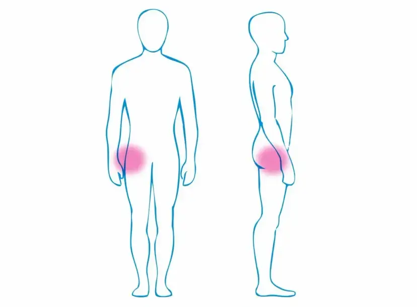 Ilustracja sylwetek ludzi z zaznaczonym na różowo bólem w okolicy bioder.