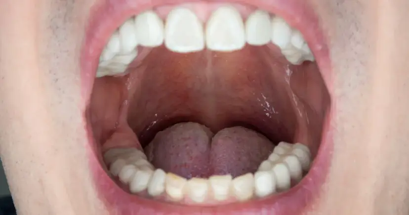Widoczne białe zęby i zaczerwienione podniebienie, gdzie może być ropień. Język jest lekko widoczny.