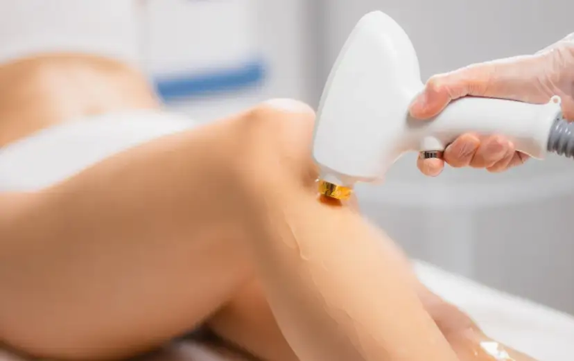 Depilacja laserowa nóg: Ile zabiegów dla gładkiej skóry na lata?