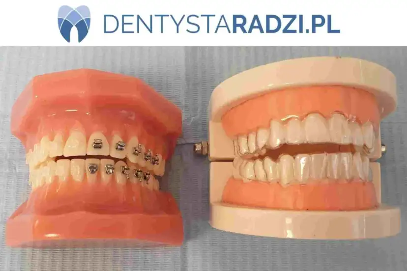 Ile nosi się aparat stały? Od czego zależy czas leczenia?