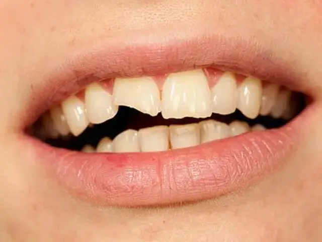 Zęby dorosłych: dlaczego wyglądają "dziwnie"? Przyczyny i jak je naprawić