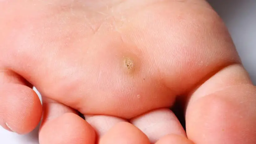 Widoczne modzele na dłoniach, z charakterystycznym, chropowatym zgrubieniem skóry w centrum.