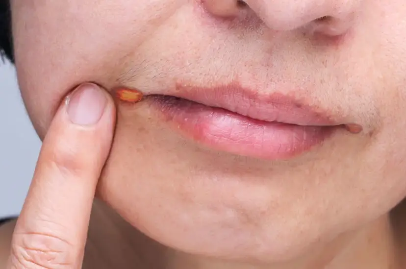 Zajady: Skuteczne leki bez recepty i kiedy do lekarza?