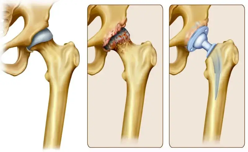 Jakie endoprotezy stawu biodrowego refunduje NFZ i co warto wiedzieć