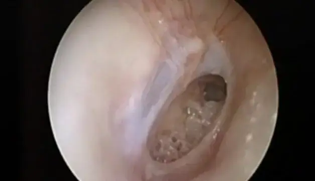 Pęknięcie błony bębenkowej u dziecka objawy – jak je rozpoznać?