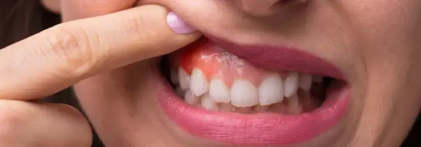 Co na spuchnięte dziąsło – skuteczne sposoby na ból i obrzęk