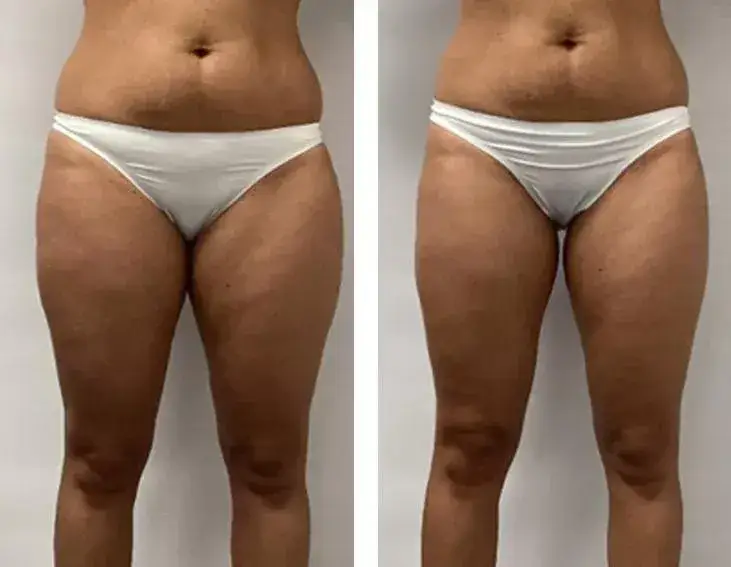 Endermologia: Kiedy efekty? Po 3 sesjach już widać! Pełna przemiana