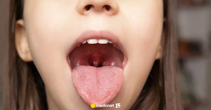 Wirus czy bakteria? Jak rozpoznać ból gardła i kiedy do lekarza?