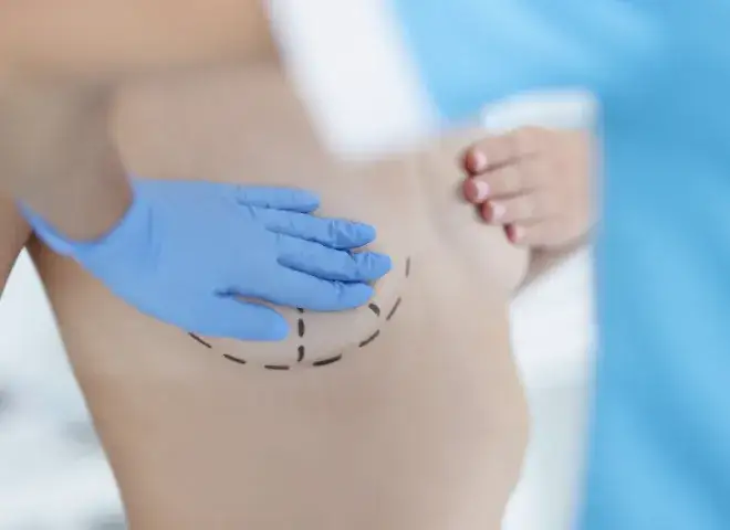 Ile kosztuje powiększenie biustu tłuszczem? Zaskakujące ceny w Polsce