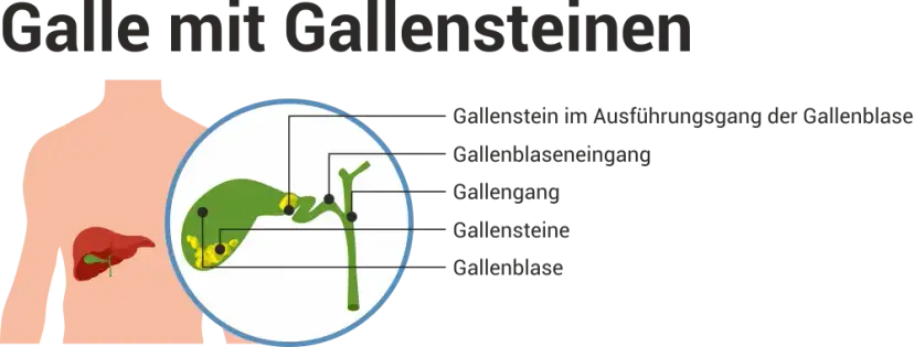 Verstopfte Gallengänge: Symptome erkennen & Ursachen verstehen