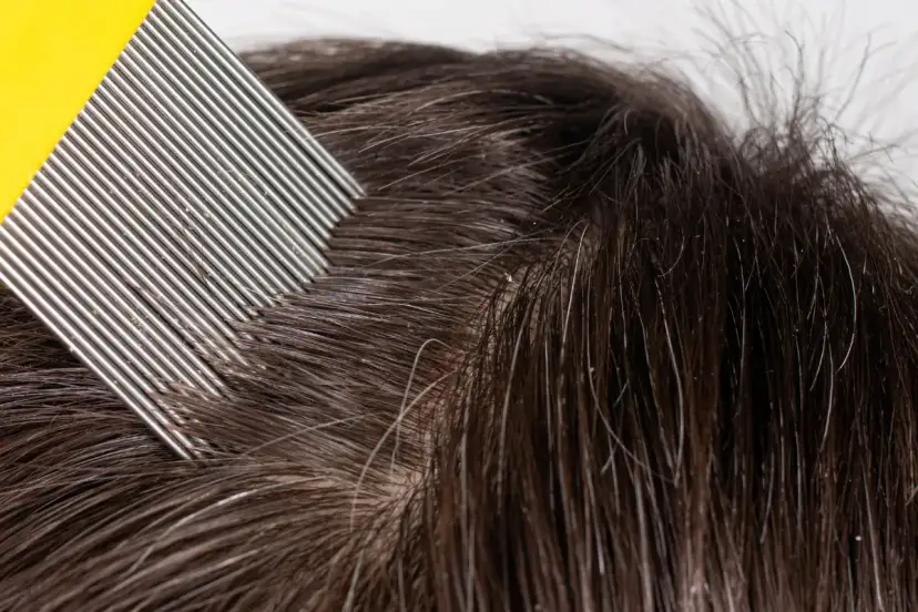 Wszy u dziecka co robić: skuteczne metody leczenia i zapobiegania