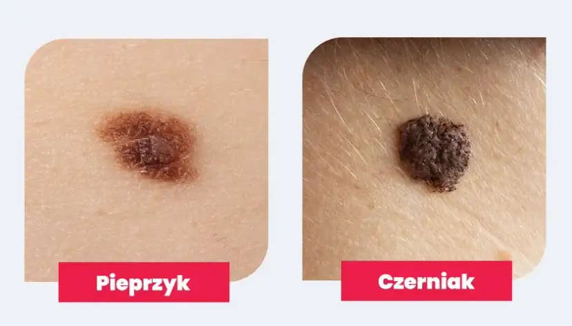 Dlaczego pieprzyk boli jak pryszcz? Objawy, które mogą niepokoić