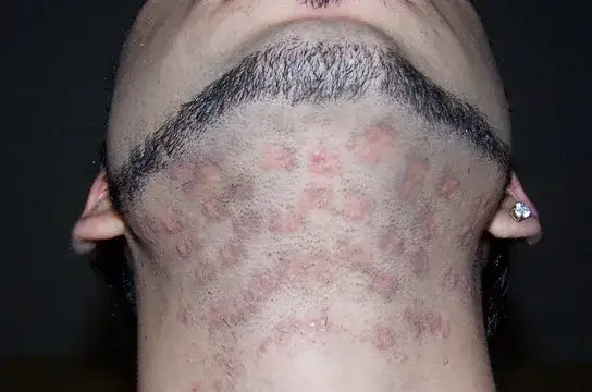 Czy można wyrywać włosy po depilacji laserowej? Skutki, które musisz znać