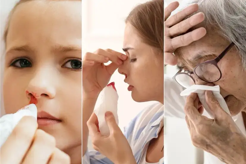 Krwawienie z nosa: Kiedy się martwić? Przyczyny, pomoc i profilaktyka