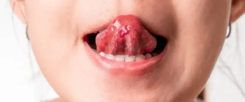 Pryszcz na języku co zrobić? Skuteczne sposoby na ulgę i leczenie
