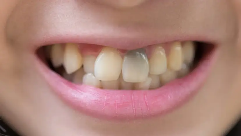 Uśmiech z jednym ciemnym, martwym zębem. Zastanawiasz się, ile wytrzyma martwy ząb?