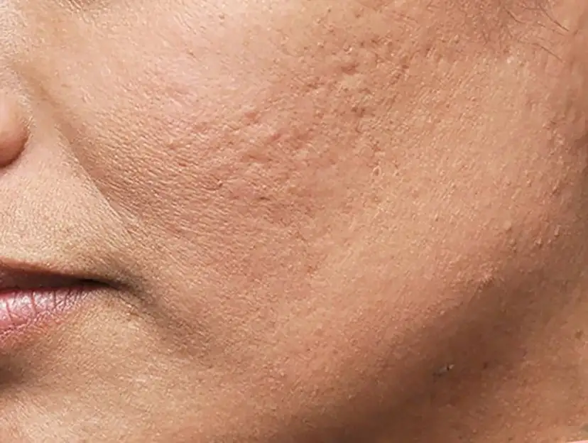 Ślady po pryszczach? Odkryj, co naprawdę działa na przebarwienia i blizny