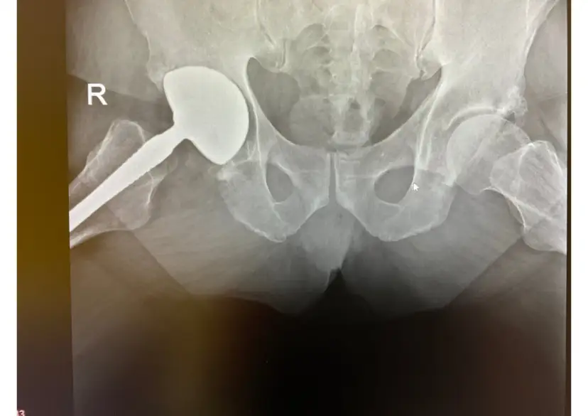 Endoproteza stawu biodrowego nfz gdzie najlepiej – wybierz mądrze