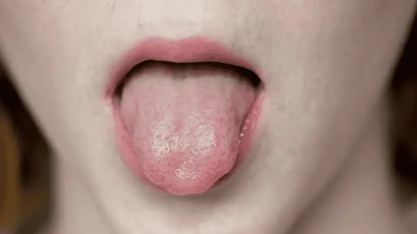 Pieczenie języka: Poznaj ukryte przyczyny i znajdź ulgę!