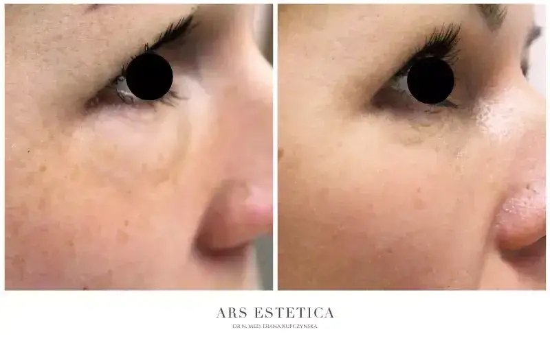 Kwas hialuronowy nie rozciąga skóry! Obalamy mit i rozwiewamy obawy