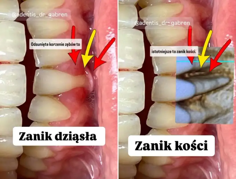 Czy dziąsła odrastają? Prawda o recesji i odbudowie dziąseł