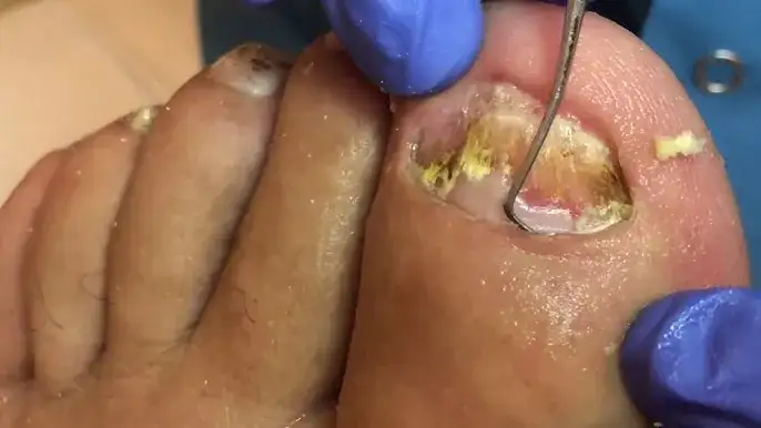 Jak obcinać paznokcie u nóg na YouTube, aby uniknąć błędów