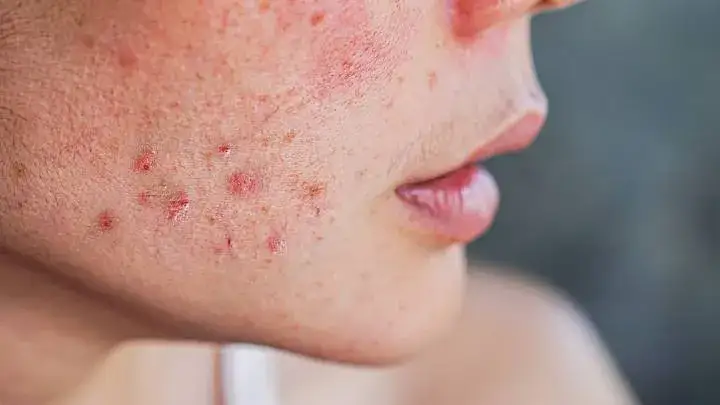 Ursachen für brennende Gesichtshaut: Symptome und wirksame Lösungen