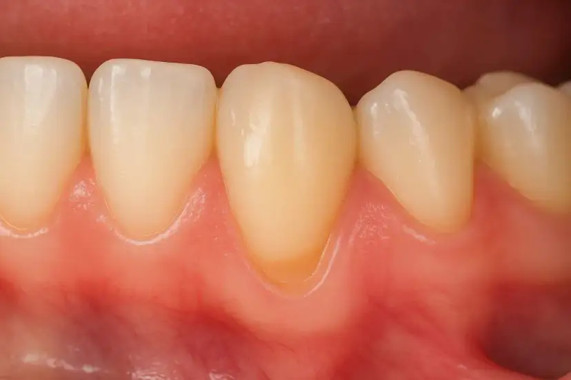 Cofające się dziąsła: jak rozpoznać i skutecznie leczyć? Poradnik