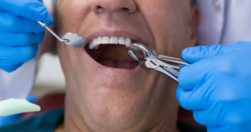 Ból po wyrwaniu zęba: ile trwa, co normą i kiedy do dentysty?