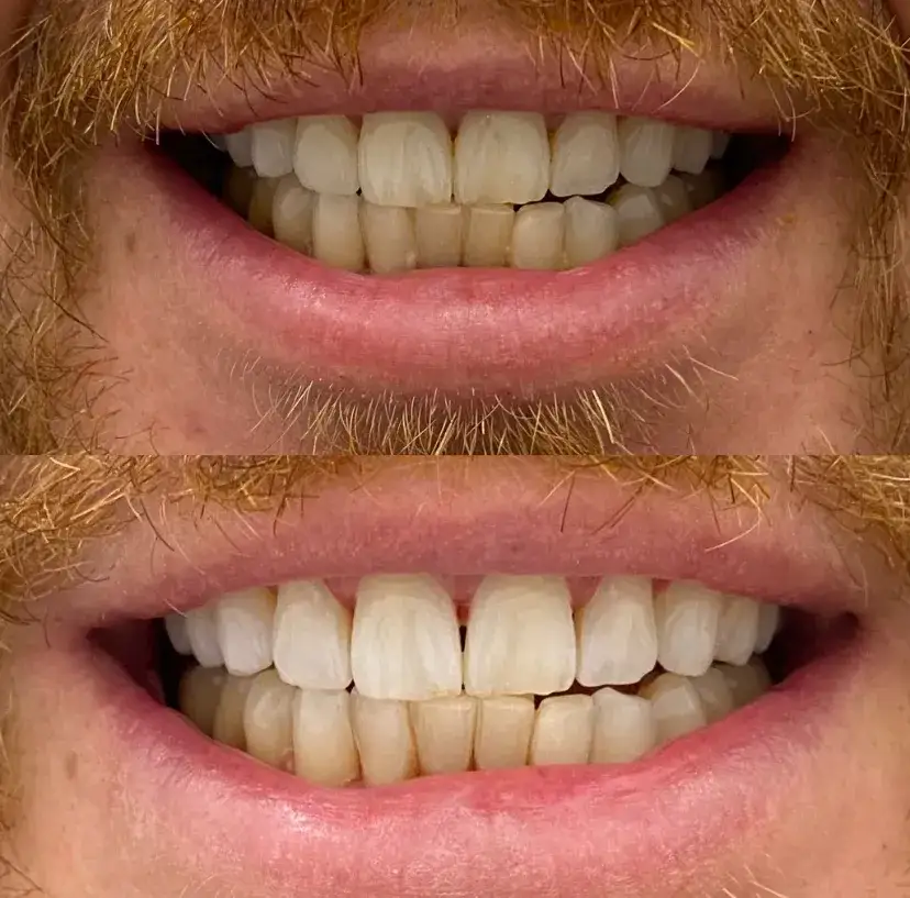 Jak wybielić zęby u dentysty - skuteczne metody i ich efekty