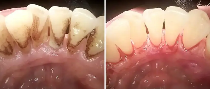 Przed i po leczeniu: zęby z osadem i oznakami ostrego zapalenia dziąseł po lewej, zdrowe dziąsła po prawej.