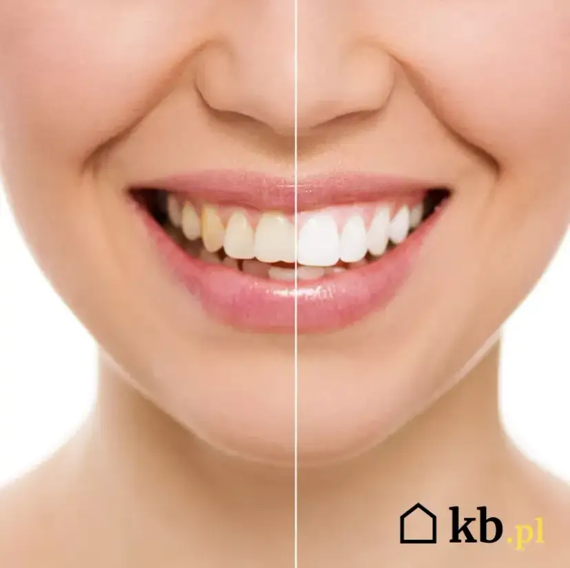 Wybielanie zębów: Ile kosztuje? Poznaj ukryte koszty!