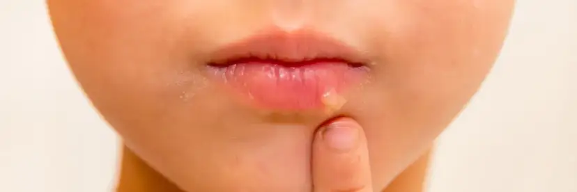 Czy dziecko z opryszczką może iść do przedszkola? Ważne informacje